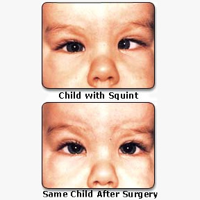 Paediatric Ophthalmology Strabismus Cl Gupta Eye Institute